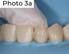 Odbudowa za pomocą matryc Bioclear Photo 3a.png