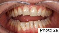 Przypadek kliniczny dr Idy Louise Line Photo 2a