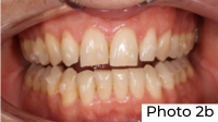 Przypadek kliniczny dr Idy Louise Line Photo 2b