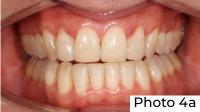 Przypadek kliniczny dr Idy Louise Line Photo 4a