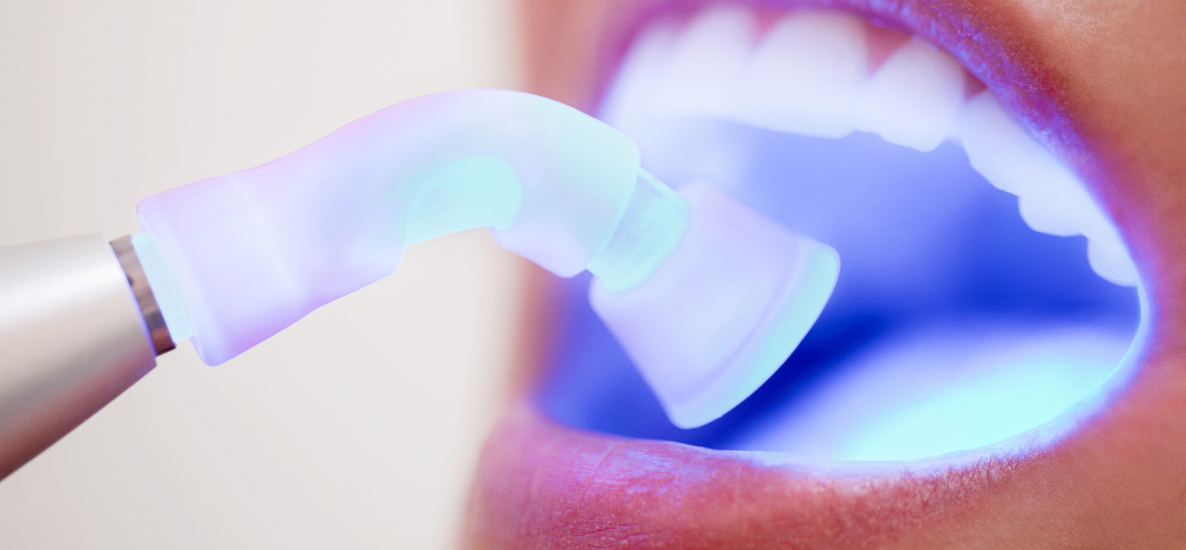 Rodzaje wypełnień zęba - plomby stomatologiczne