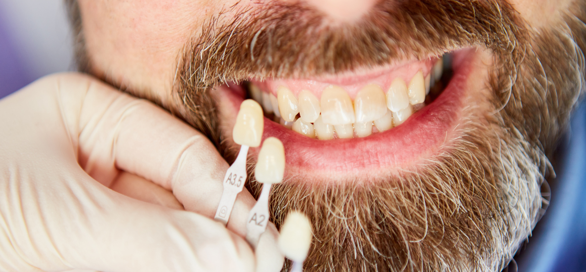 Przebarwienia zębów - skąd się biorą i jak z nimi walczyć?