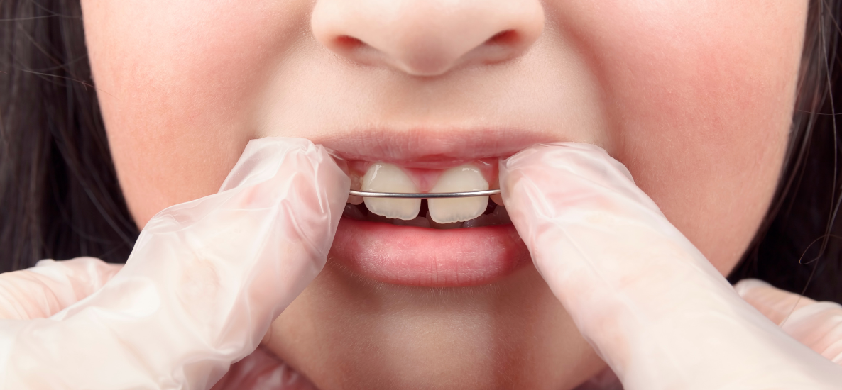 Twin Block, Bionator czy aparat Herbsta – który aparat czynnościowy wybrać w leczeniu klasy II?