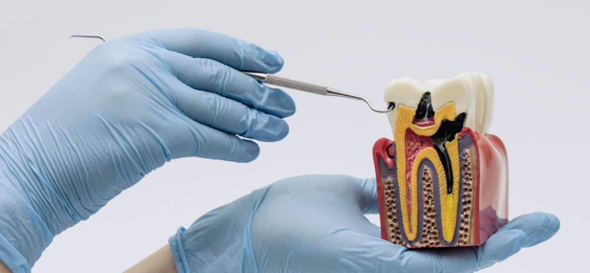 Jakie jest zastosowanie stomatologiczne wodorotlenku wapnia?