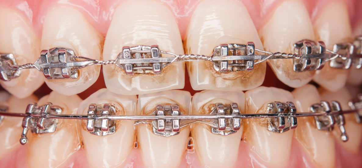 Białe plamy wokół zamków (WSL – white spot lesions) – wyzwanie profilaktyczne w ortodoncji