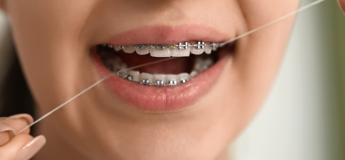 Profilaktyka próchnicy podczas leczenia ortodontycznego