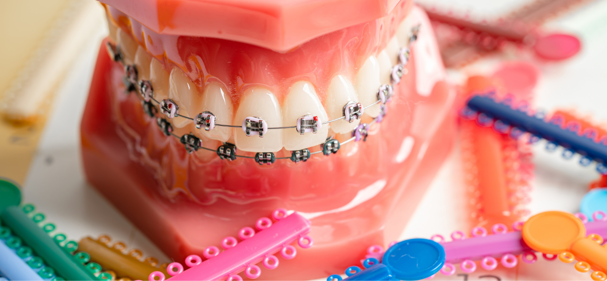 Dehiscencje i fenestracje kostne w ortodoncji – najczęstsze pytania i odpowiedzi