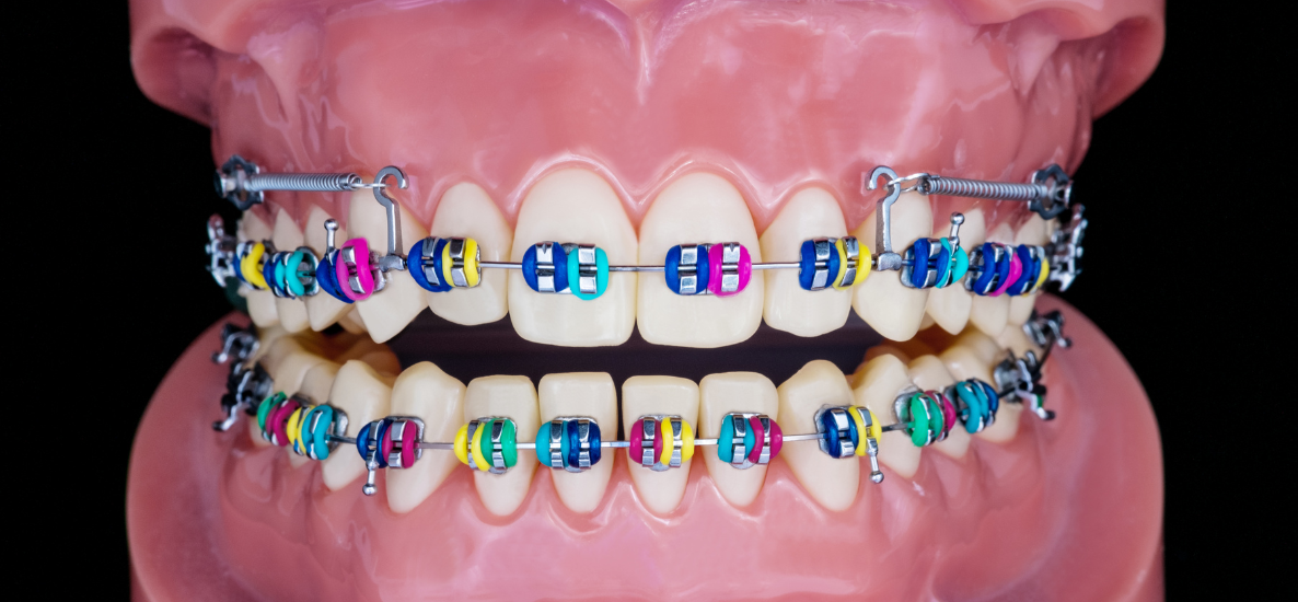 Trudne przypadki zgryzu otwartego – diagnoza, leczenie, pułapki kliniczne