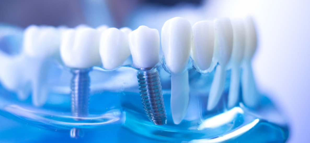 Interdyscyplinarne leczenie wad zgryzu - współpraca ortodonty i implantologa