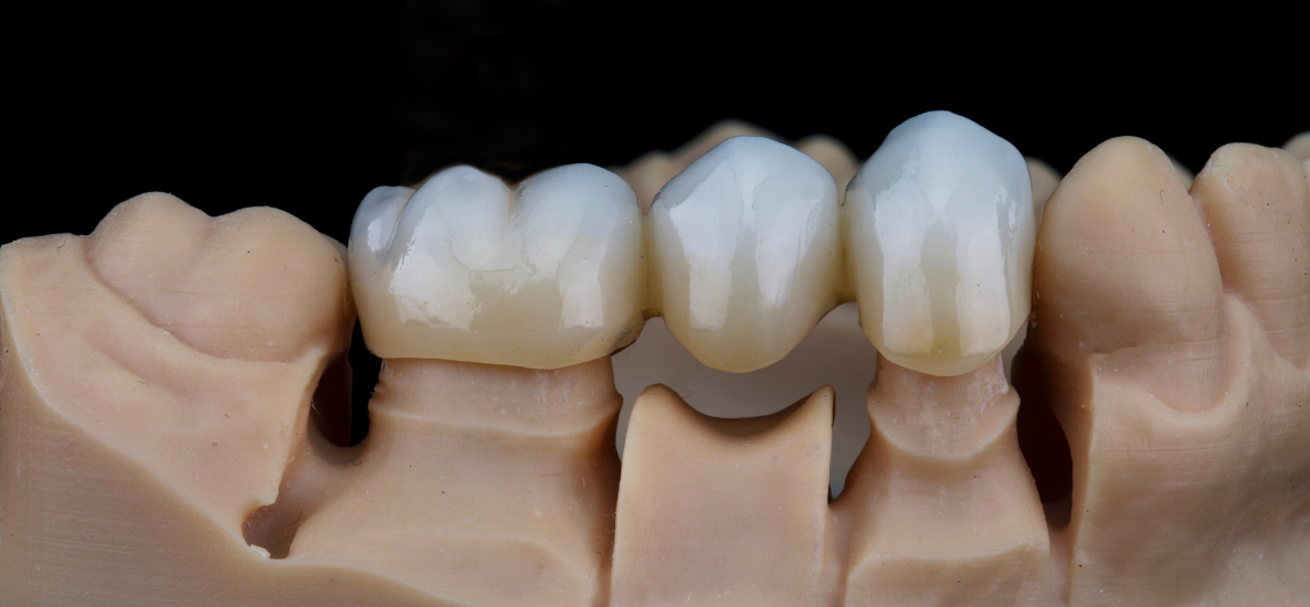 Jak poprawnie przygotować ząb pod koronę protetyczną? Kluczowe zasady szlifowania