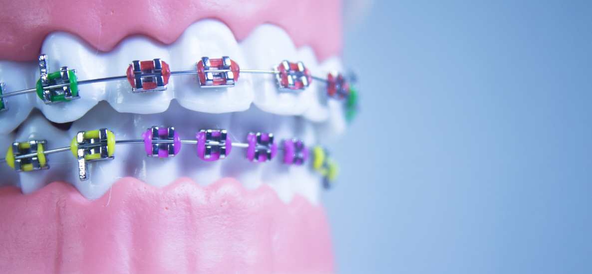 Trójwymiarowa analiza remodelingu przyzębia w trakcie leczenia ortodontycznego