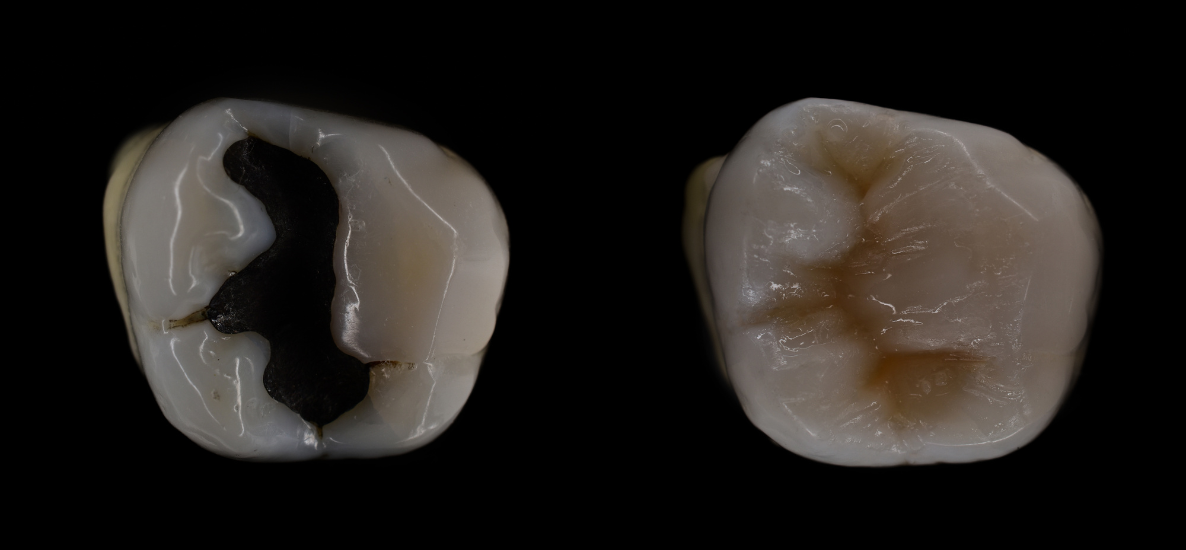 Jakie są najlepsze metody usuwania starych wypełnień amalgamatowych?