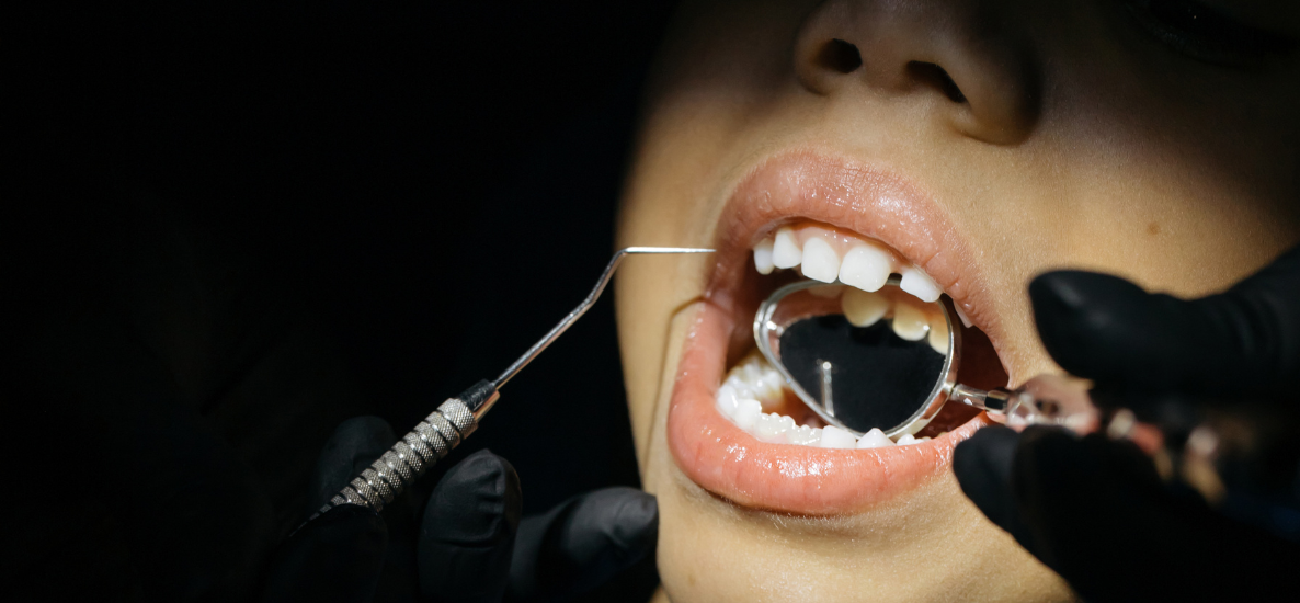 Dlaczego zatrzymany górny siekacz przyśrodkowy jest wyzwaniem dla ortodonty?