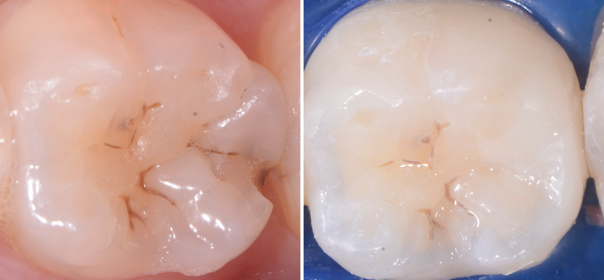 Bruksizm i wypełnienia w odcinku bocznym: Wybór prawidłowego rozwiązania dla długotrwałego zdrowia jamy ustnej