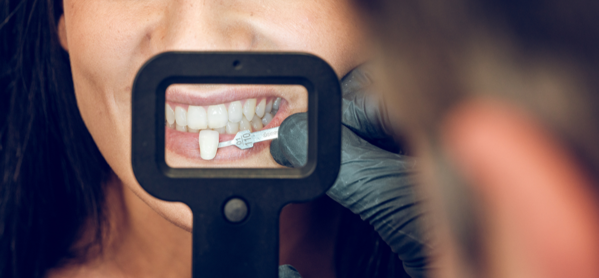Licówki na zęby - kluczowe informacje dla stomatologów przed ich założeniem