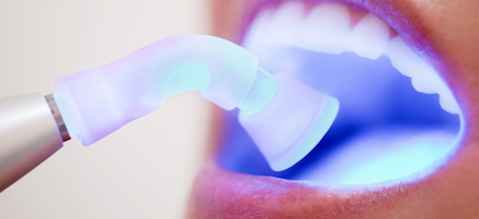 Rodzaje wypełnień zęba - plomby stomatologiczne