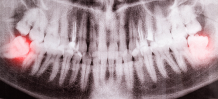 Ekstrakcja zębów zatrzymanych - praktyczna wiedza dla stomatologów