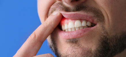 Powody stanów zapalnych zębów i sposoby ich zwalczania