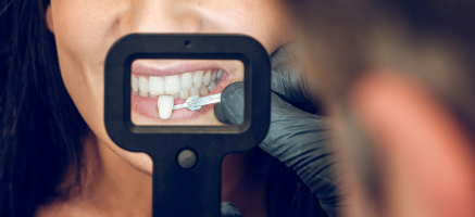 Licówki na zęby - kluczowe informacje dla stomatologów przed ich założeniem